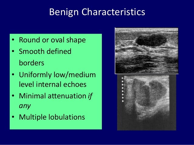solid mass breast Solid mass breast